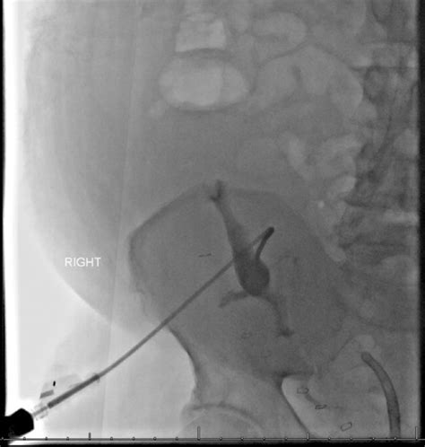 Interventional Radiology Guided Percutaneous Nephrostomy And