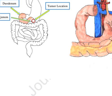 Duodenum Seen All Parts The Ligament Of Treitz Is Observed The