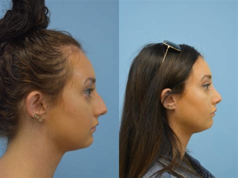 Nose Surgery Before And After Photos Patient 198 San Francisco Ca