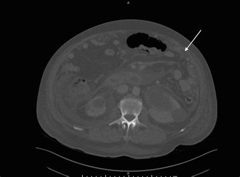 Cureus Prostate Cancer Metastatic To The Peritoneum A Road Less