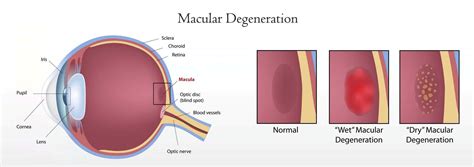 Macular Degeneration Eye Chart