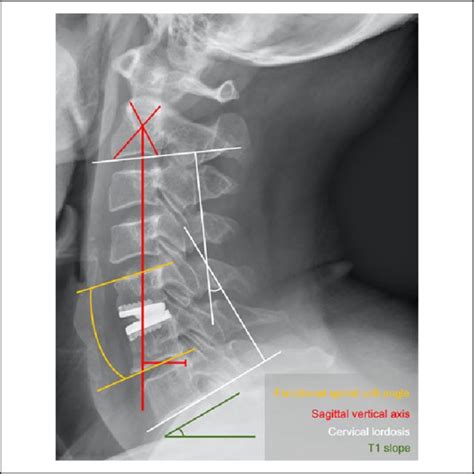 Radiological Evaluation Of The Cervical Sagittal Alignment After