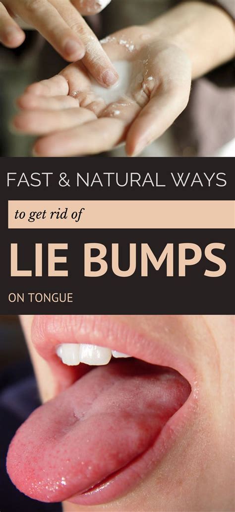 Fast And Natural Ways To Get Rid Of Lie Bumps On Tongue Bumps On