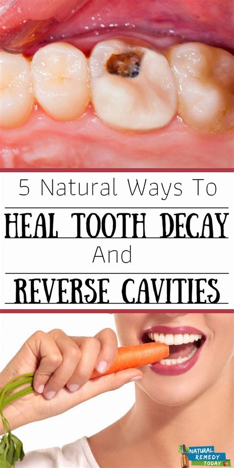 Read all about cavity symptoms, rotten teeth causes, how to prevent them and how to we'll also go over how tooth decay leads to cavities and rotten teeth and ways to stop the infection developing this far. reverse tooth decay + tooth decay + tooth decay remedies ...