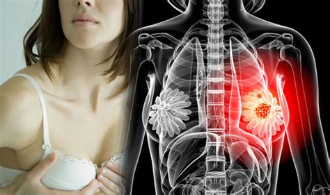 When you're told that you have stomach cancer, it's natural to wonder what may have caused the disease. Breast cancer symptoms: How do you know if you have the ...
