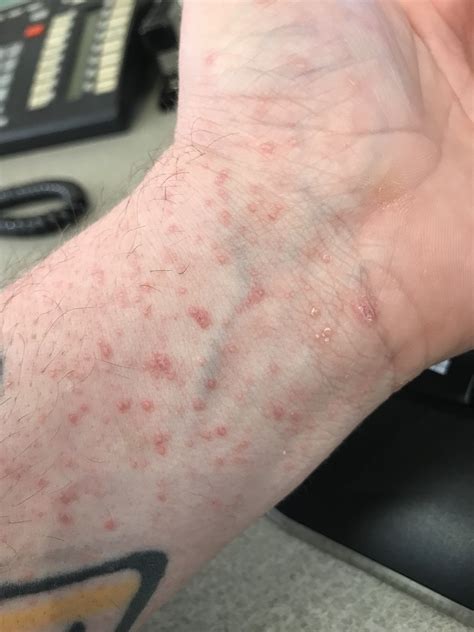 Itchy Bumps On Forearms