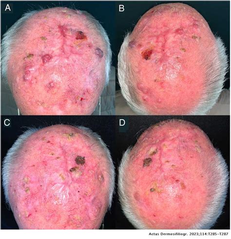 Translated Article Locally Advanced Cutaneous Squamous Cell Carcinoma