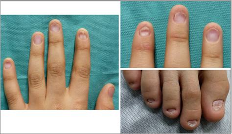 Image Gallery Spoon‐shaped Nails In An 11‐year‐old Boy Calleja