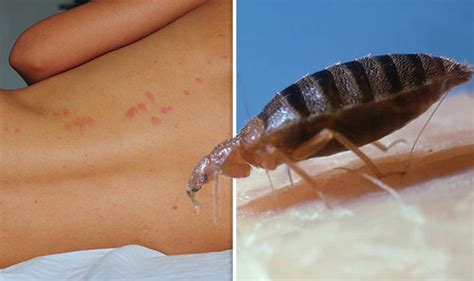 Bed Bugs Six Ways To Treat Bites If Youve Been Bitten