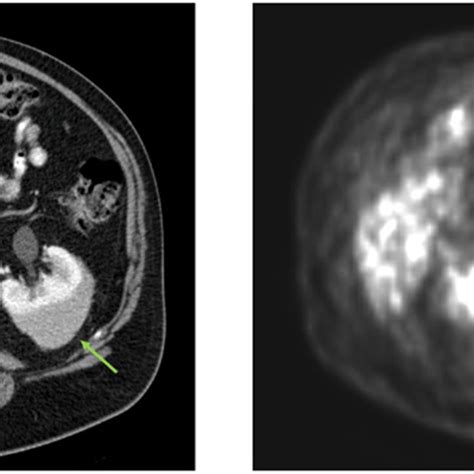 Computed Tomography Ct Wcontrast Showing An Enhancing 9 × 5cm Left