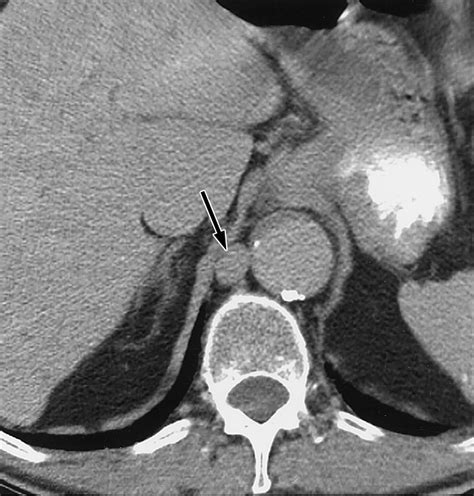 Cisterna Chyli At Routine Abdominal Mr Imaging A Normal Anatomic