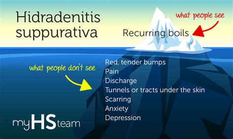Hidradenitis Suppurativa Hs What People Dont See Infographic