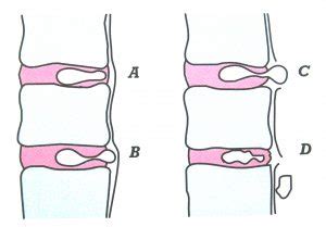 Une hernie discale lombaire se caractérise par une douleur localisée en bas du dos. La hernie discale expliquée - Douleur-Info.com - Douleurs ...