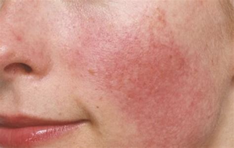 Top 6 Reasons Why Your Skin Is Red And Common Rosacea Misdiagnosis