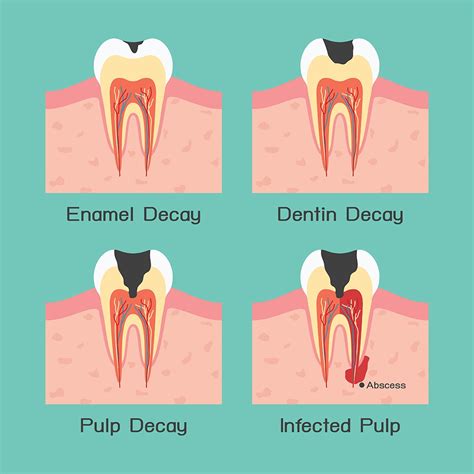 How To Treat Exposed Tooth Root