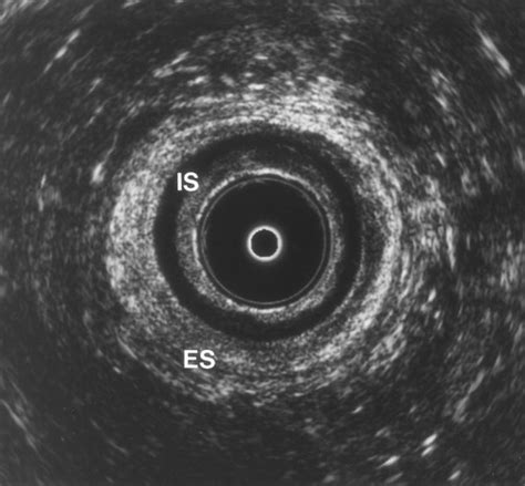 Endoanal Mr Imaging Of The Anal Sphincter In Fecal Incontinence