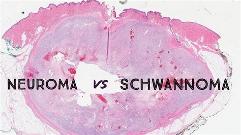 Neuroma Vs Schwannoma Palisaded Encapsulated Neuroma Nerve Sheath