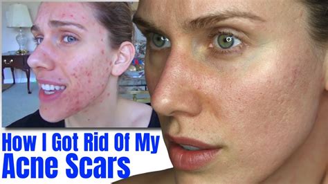 Acne Scar Update How I Got Rid Of My Acne Scars Youtube