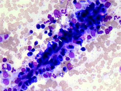 Normal Plasma Cell Distribution Along Bone Marrow Sinusoid 1