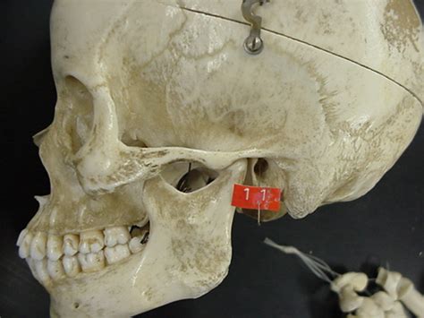 We did not find results for: External Acoustic Meatus