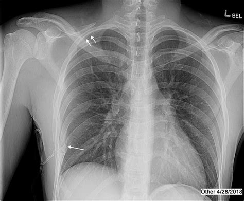 Postoperative Chest X Ray Showing A Trace Pneumothorax Double Arrow