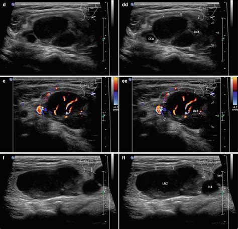 Other Malignancies In Thyroid Gland And Cervical Lymph Nodes