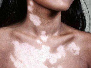 Skin bleaching is temporary and dangerous. The most useful methods to get rid of white spots on skin