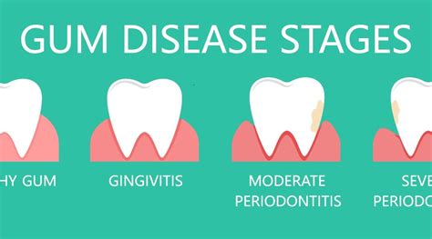 How Is Periodontal Disease Treated By Your Dentist Tc Dental Group