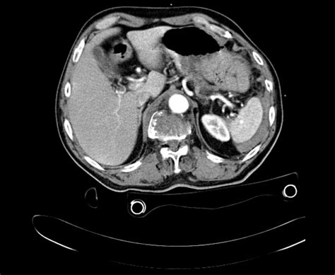 Ct Scan Showing Contrast Blush In Grade Ii Splenic Injury Which Was