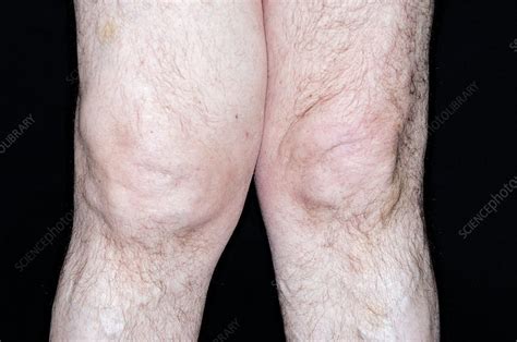 Swollen Knee In Osteoarthritis Stock Image C0110408 Science