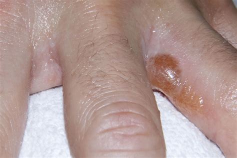 Postangioedema Attack Skin Blisters An Unusual Presentation Of