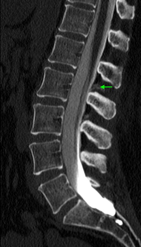 Ct Myelogram Of The Lumbar Spine Revealing Extradural Contrast