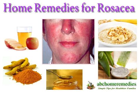 Home Remedies For Rosacea