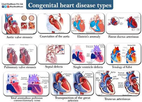 Congenital Heart Disease Classification Congenital Heart Disease