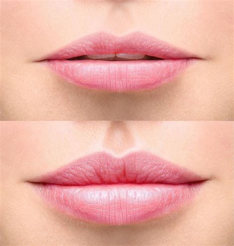 Lips Fillers Do Not Make Lips Look Fake Or Overdone When Applied