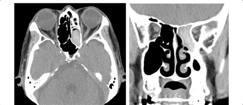 Computed Tomography Of Paranasal Sinuses Revealing High Attenuation