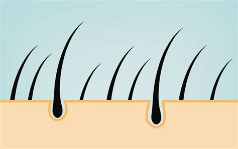 Hair Follicle Structure Ingrown Infected Folliculitis Lump Swollen