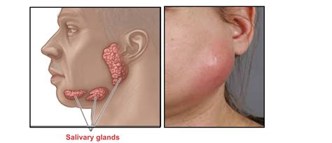 Infected Salivary Glands Can Cause A Lump Under Jaw Or Jaw Line Jawline Scalp Bumps