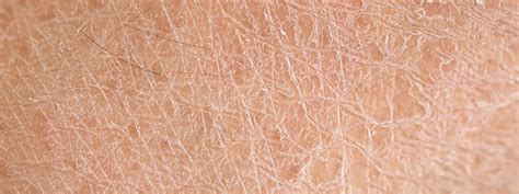 Dry Skin Causes Treatment Remedies And How To Get Rid Of It