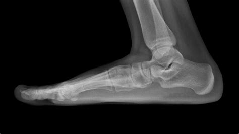 Bone Spur On Top Of Foot Explained By A Foot Specialist