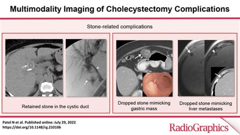 Multimodality Imaging Of Cholecystectomy Complications Radiographics