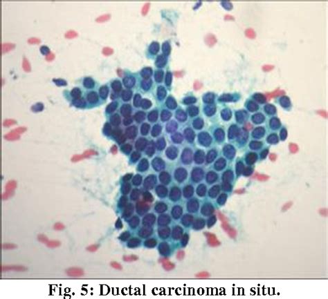 Figure 1 From Study Of Fine Needle Aspiration Cytology Of Breast