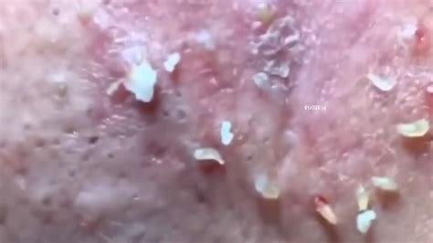 Best Removal Pimple Popping Blackheads Whiteheads On The Face Acne