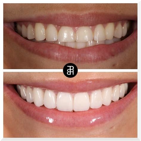 What Everybody Ought To Know About Dental Veneers Part I The