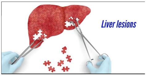 Liver Lesions Cause Symptoms And Treatment