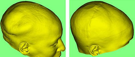 Parietal Skull Reconstruction Using Immediate Peek Cranioplasty