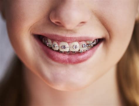 Is There More Than One Type Of Dental Braces Village Orthodontics