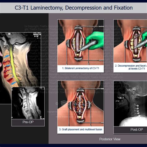 C3 T1 Laminectomy Decompression And Fixation Trialexhibits Inc