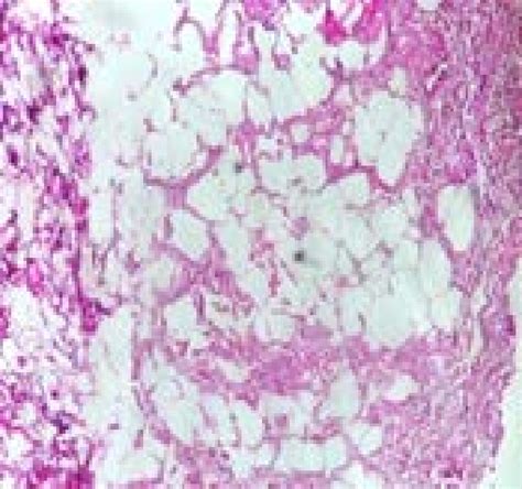 Histopathology Of Tongue Fibrolipoma Showing Matures Adipocytes In An