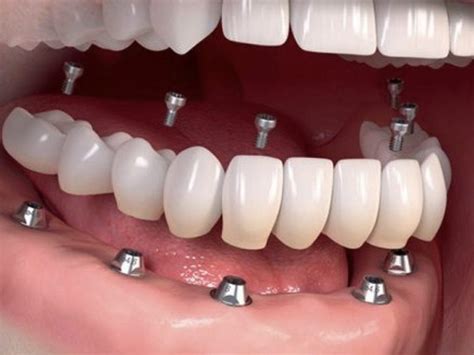 Dentaduras Completas Sobre Implantes Clinicas Dentales Elena Tejero